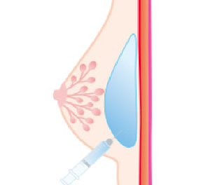ヒアルロン酸注入豊胸