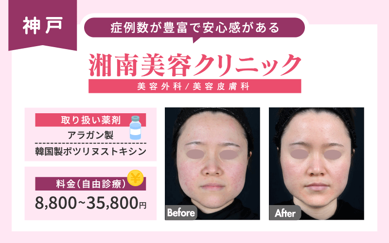 エラボトックス　神戸　湘南美容クリニック　図解