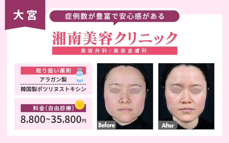 エラボトックス 大宮 湘南美容クリニック 図解