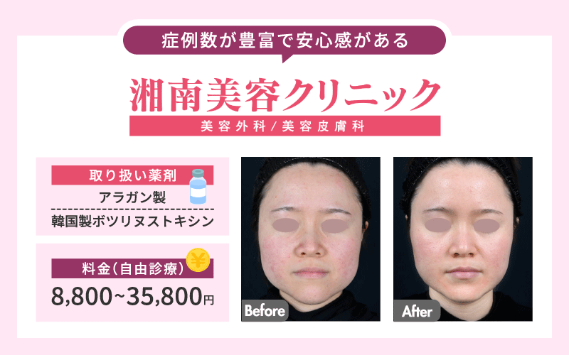 エラボトックス　おすすめ　湘南美容クリニック