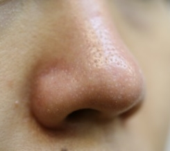 毛穴 レーザー の 鼻 いちご鼻の毛穴はレーザーで治療？効果の実態や費用まとめ！